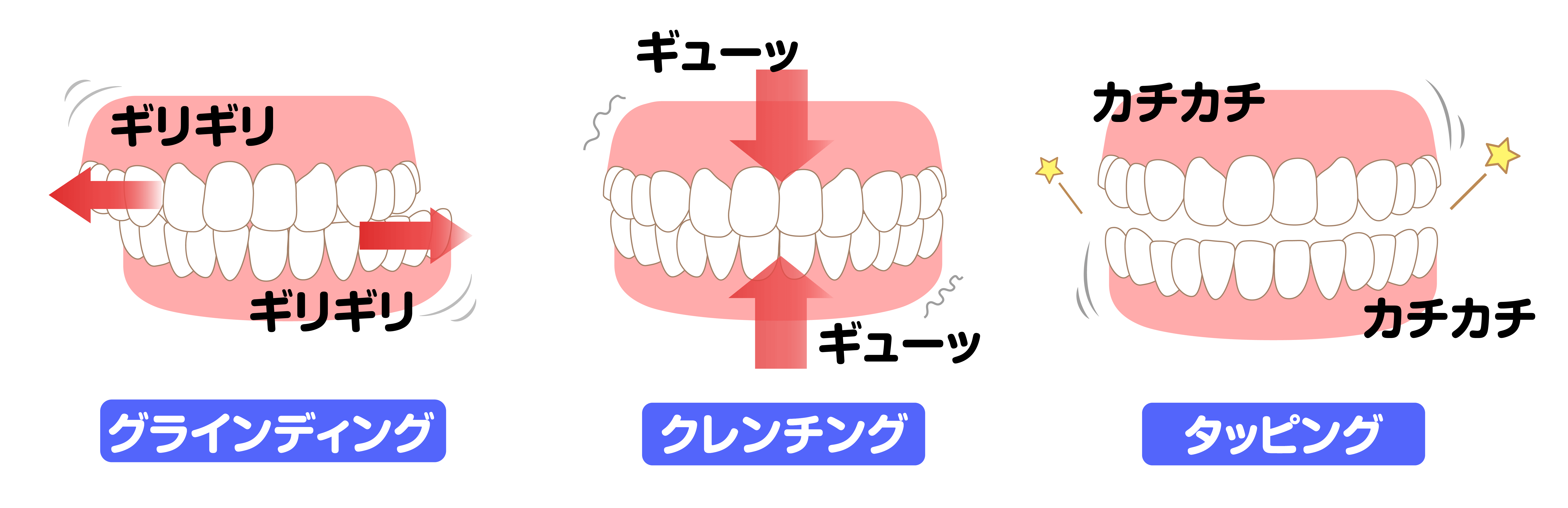 歯ぎしりの種類